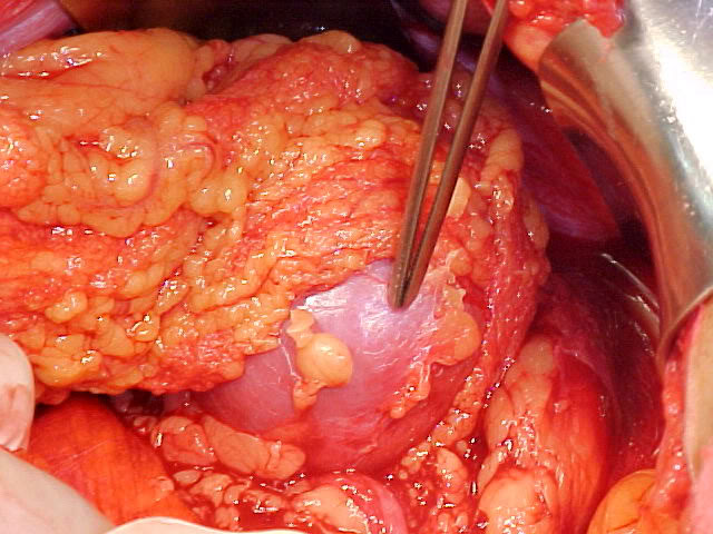 Omental Patch Repair Duodenal Ulcer